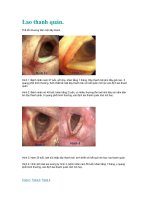 Tài liệu Lao thanh quản. pptx