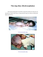Tài liệu Não úng thủy (Hydrocephalus) doc