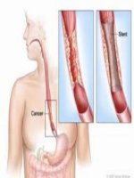 Tài liệu UNG THƯ THỰC QUẢN pptx