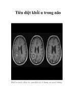 Tiêu diệt khối u trong não