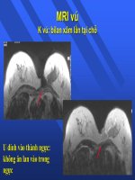 Tài liệu MRI chỉ định chụp vú_Phần 2 pdf