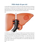 Tài liệu Giáo trình Phẫu thuật cắt gan trái doc