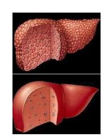 Người gan nhiễm mỡ ăn gì? potx