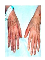 Bài thuốc trị thống phong pptx