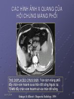 Chuẩn đoán X quang hội chứng màng phổi ppt