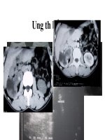 ẢNH U ĐƯỜNG BÀI XUẤT