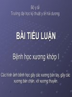 XQ Gãy Xương Bàn Chân