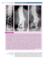 Spinal Disorders: Fundamentals of Diagnosis and Treatment Part 73 pot