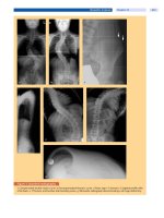 Spinal Disorders: Fundamentals of Diagnosis and Treatment Part 65 pptx