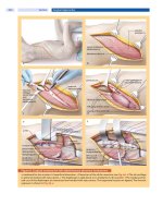 Spinal Disorders: Fundamentals of Diagnosis and Treatment Part 38 pot