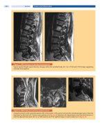 Spinal Disorders: Fundamentals of Diagnosis and Treatment Part 97 docx