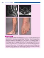 Spinal Disorders: Fundamentals of Diagnosis and Treatment Part 32 ppsx