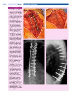 Spinal Disorders: Fundamentals of Diagnosis and Treatment Part 98 pot