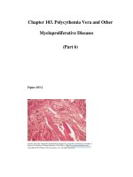 Chapter 103. Polycythemia Vera and Other Myeloproliferative Diseases (Part 6) ppt