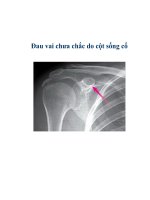 Đau vai chưa chắc do cột sống cổ pot