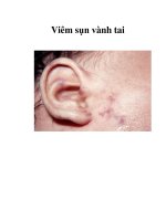 Viêm sụn vành tai potx