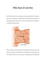 Phẫu thuật cắt ruột thừa doc