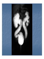 Bài giảng một số bất thường bẩm sinh bộ máy tiết niệu part 10 pot