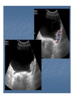 Bài giảng bệnh lý hay gặp của bàng quang part 10 docx