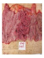 Giải phẫu bệnh - U biểu mô, U liên kết part 5 pps