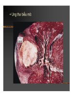 Giải phẫu bệnh - Ung thư part 2 doc