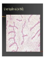 Giải phẫu bệnh - U biểu mô, U liên kết part 8 ppsx
