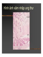 Giải phẫu bệnh - Ung thư part 3 pptx