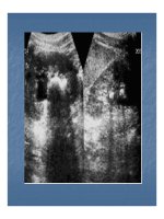 Bài giảng sỏi hệ tiết niệu part 7 ppsx