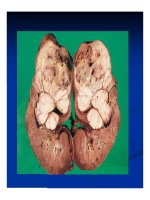 Giải phẫu bênh - Ung thư phổi và ung thư thận part 7 ppsx