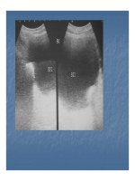 Bài giảng bệnh lý hay gặp của bàng quang part 5 pptx