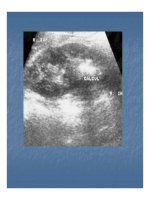 Bài giảng một số bất thường bẩm sinh bộ máy tiết niệu part 7 pps