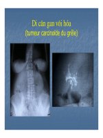 Bài giảng sỏi hệ tiết niệu part 4 pps