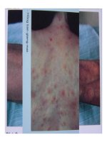 Bài giảng bệnh phong part 5 docx