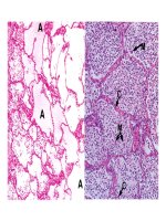Bài giảng bệnh học viêm part 7 potx