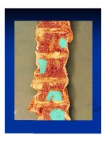 Giải phẫu bênh - Ung thư phổi và ung thư thận part 6 docx