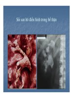 Bài giảng sỏi hệ tiết niệu part 2 pdf