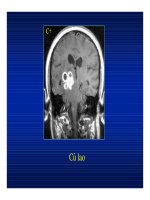 Bệnh viêm nhiễm ở não part 9 doc