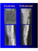Chẩn đoán TRẬT KHỚP QUANH NGUYỆT part 5 ppt