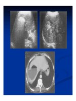 Chẩn doán hình ảnh : Gan - Mật part 9 docx