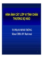 HÌNH ẢNH CẮT LỚP VI TÍNH CHẤN THƯƠNG SỌ NÃO part 1 doc