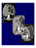 Viêm tụy cấp và mãn tính part 6 ppt