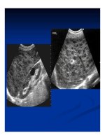 Chẩn doán hình ảnh : Gan - Mật part 7 pptx