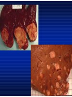 Chẩn doán hình ảnh : U Gan part 8 potx