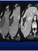 Chẩn doán hình ảnh : U Gan part 3 ppt