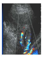 Chẩn đoán bằng hình ảnh : Siêu âm bụng part 8 pdf