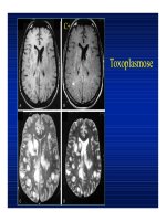 Bệnh viêm nhiễm ở não part 8 ppsx