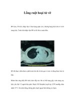 Lồng ruột hoại tử vỡ pps