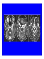 Bài giảng chẩn đoán và điều trị Viêm màng não part 6 pptx