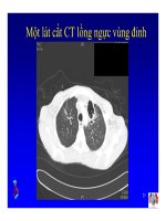 Bài giảng điều trị HIV : Các hội chứng hô hấp trong nhiễm HIV part 6 docx