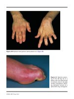 PARKINSON’S DISEASE AND RELATED DISORDERS - PART 8 ppt